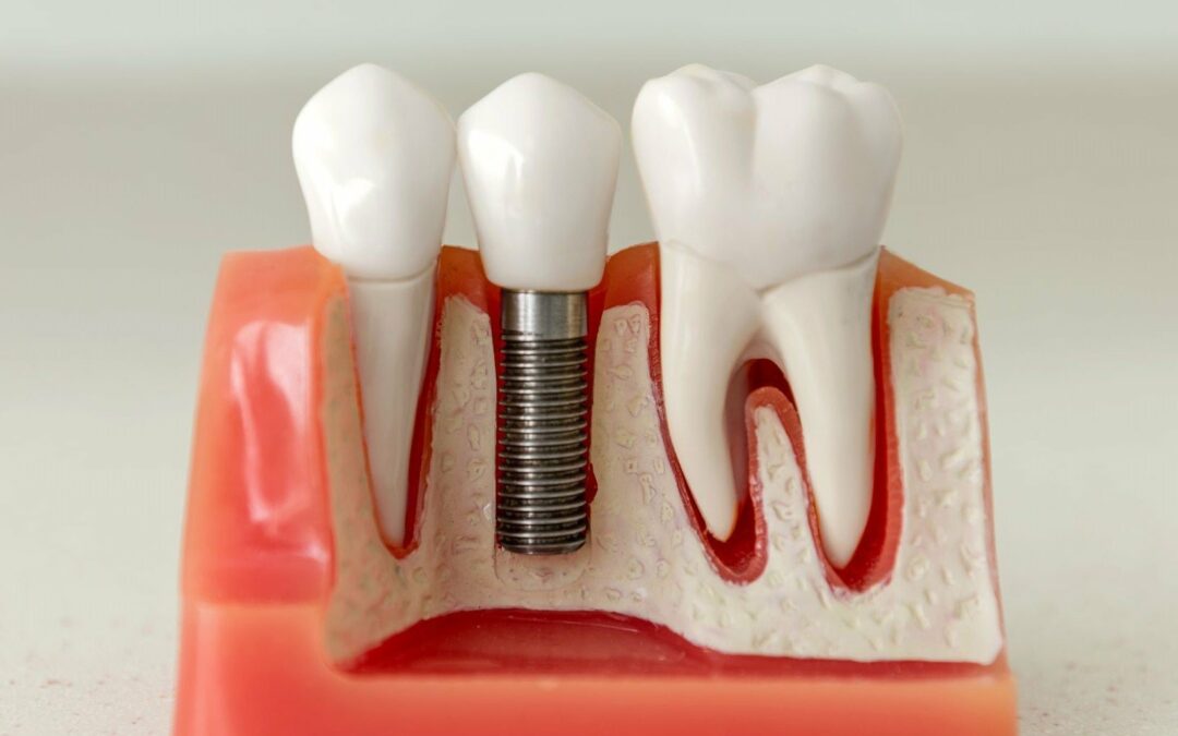 Precios de implantes dentales