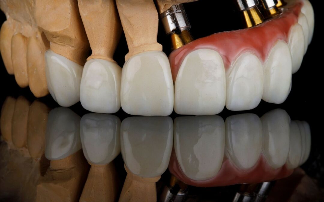 Carillas dentales en Sevilla