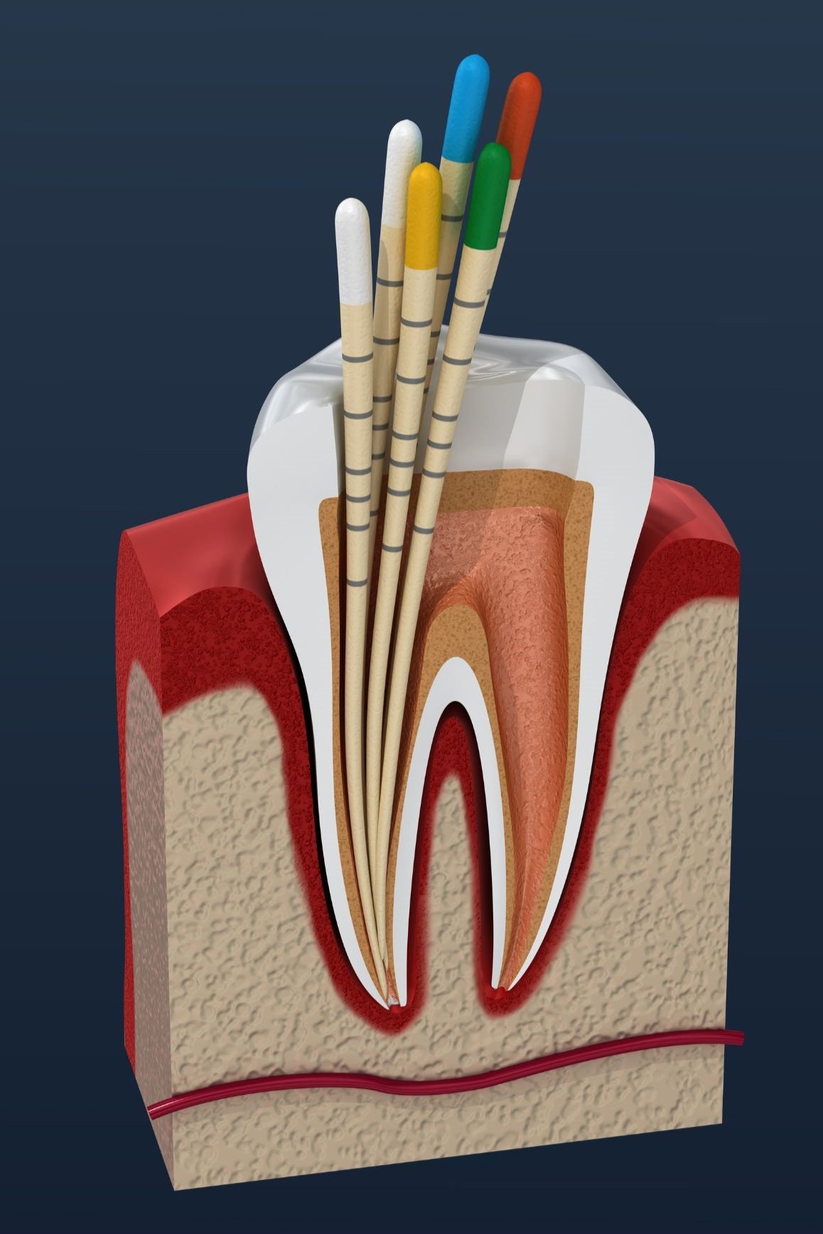 tratamiento de endodoncia