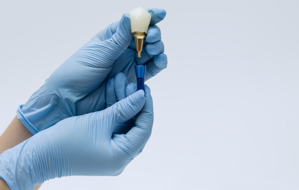 Implantes dentales - cuánto duran y cuando hay que cambiarlo - Clínica dental FOS