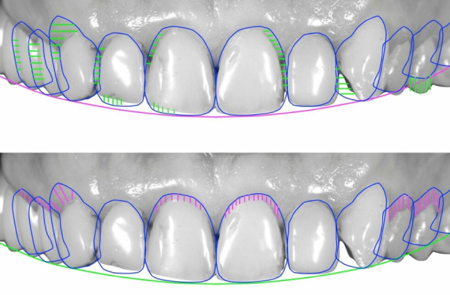 proceso invisalign - escaneo digital proceso invisalign - escaneo digital