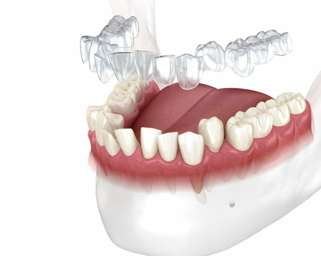 proceso invisalign - fabricación de alineadores proceso invisalign - fabricación de alineadores